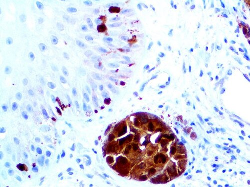 IHC of S100A1 on an FFPE Melanoma Tissue